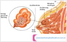 Sự tăng trưởng không bình thường của tuyến vú là gì và cần làm thế nào?
