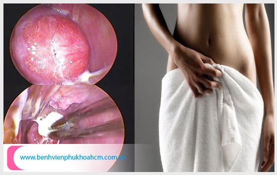 5 biểu hiện của viêm lộ tuyến cổ tử cung