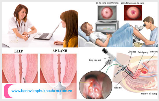 Điều trị viêm lộ tuyến cổ tử cung bằng Dao LEEP