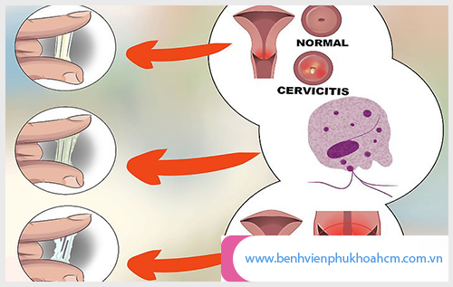 Biểu hiện khí hư bất thường rất nhiều