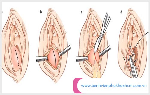 Cần đến phòng khám uy tín ngay khi viêm tuyến bartholin bị vỡ