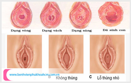 Các hình dạng màng trinh ở nữ giới