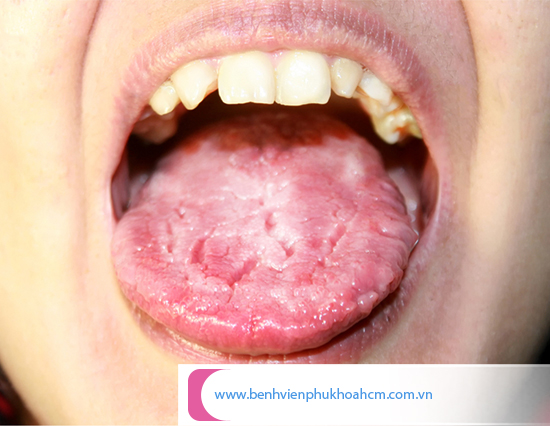 dấu hiệu nhiễm trùng nấm candida ở miệng