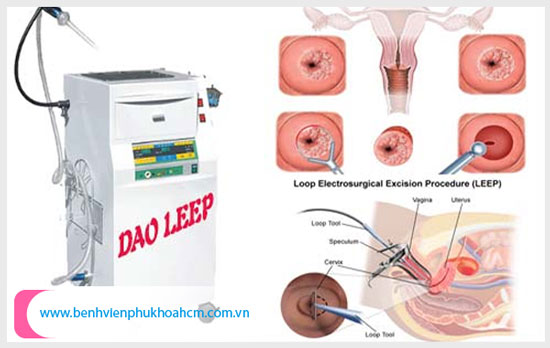 Điều trị viêm lộ tuyến hiệu quả và an toàn bằng Dao LEEP
